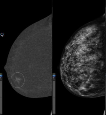 Contrast-enhanced diagnostic mammogram image