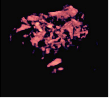 3D color Doppler sonogram of vascular network within malignant uterine polyp.